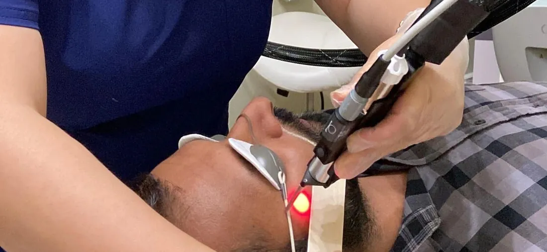 Laser hair removal on a man's beard line and neck